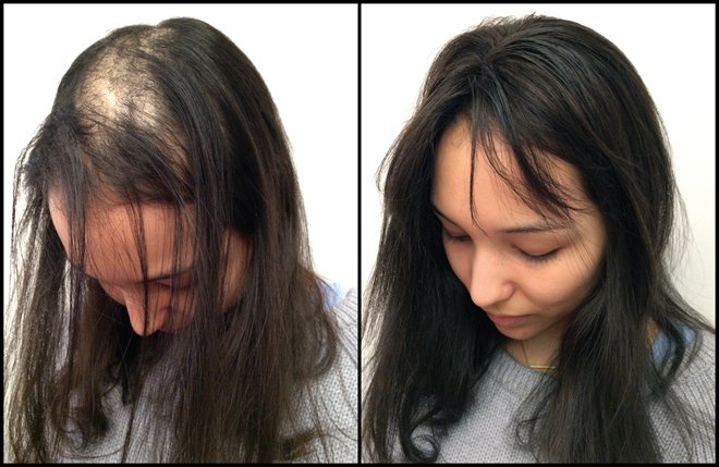 Topo De Cabeça (Cabelo Humano) - Para Alopecia, Falhas, Cabelos Ralos e com Queda